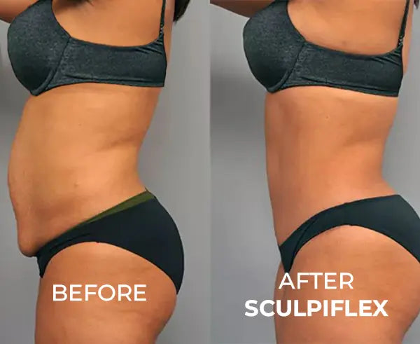 SculpiFlex™ - Appareil de Sculpture Corporelle